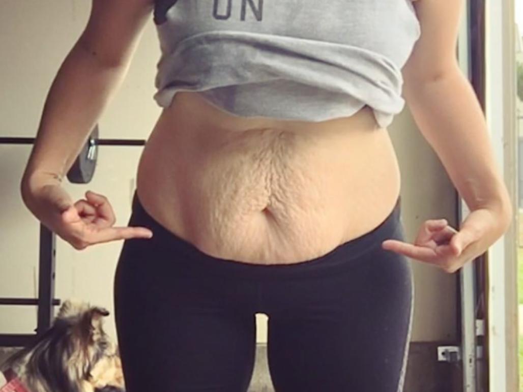 17 Women Share Pics of Loose Skin After Weight Loss to Prove How Common and Normal It Is